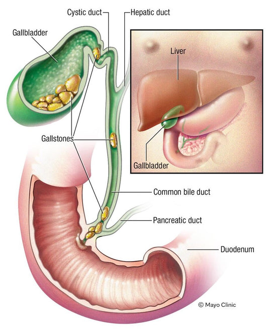 30-Day Gallbladder Detox